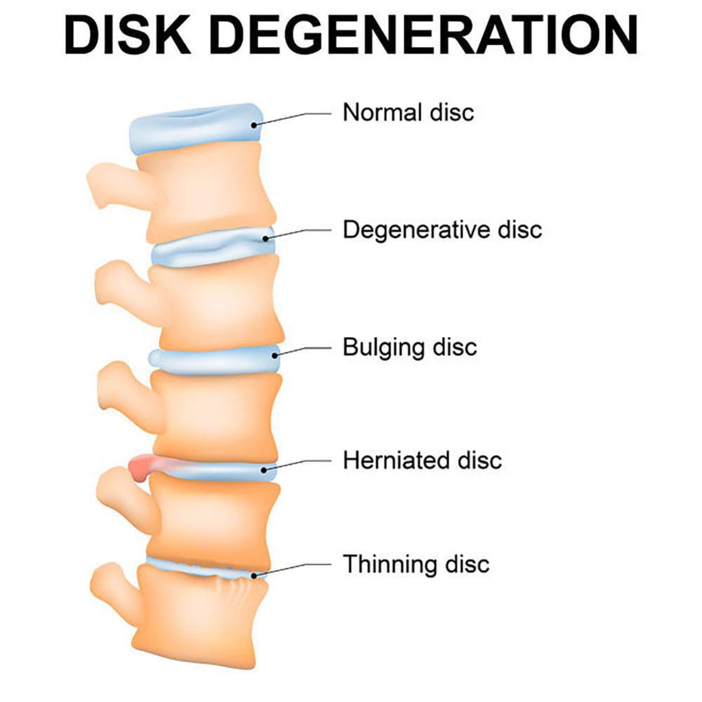 graphic of disc degeneration