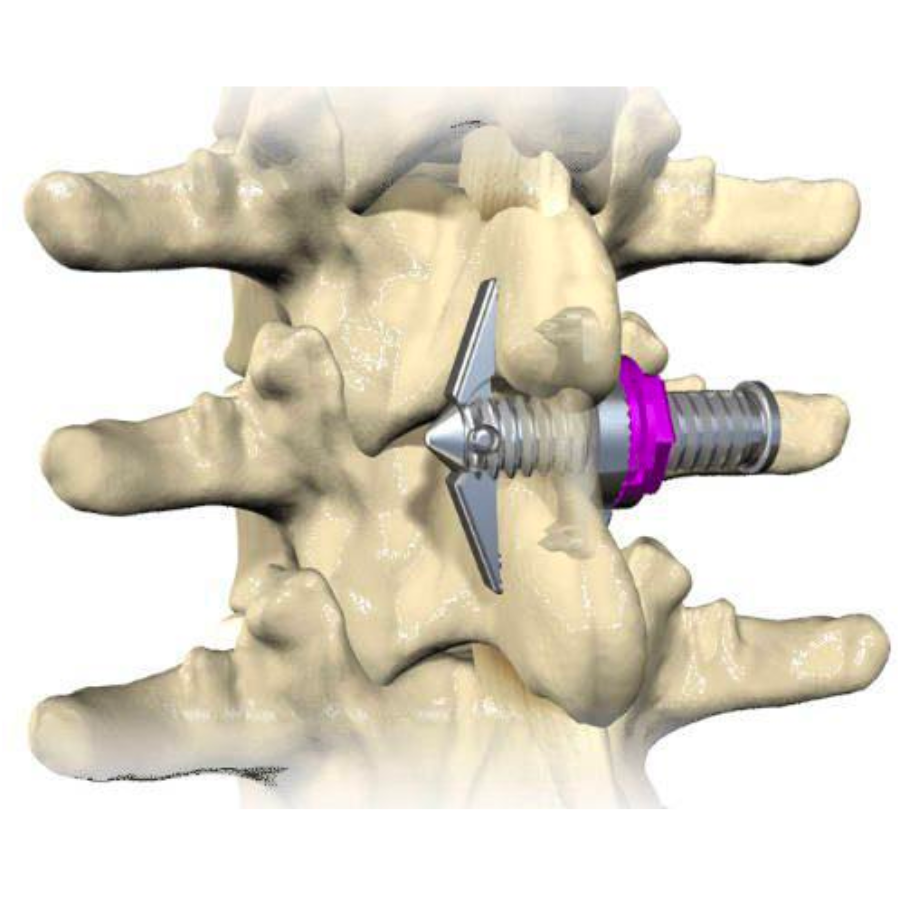 graphic model of minuteman procedure in spine