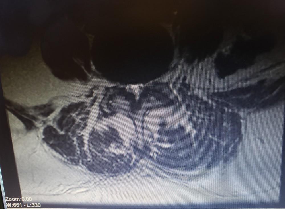 xray spinal stenosis