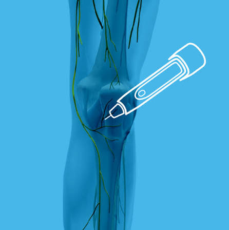 iovera° for knee pain